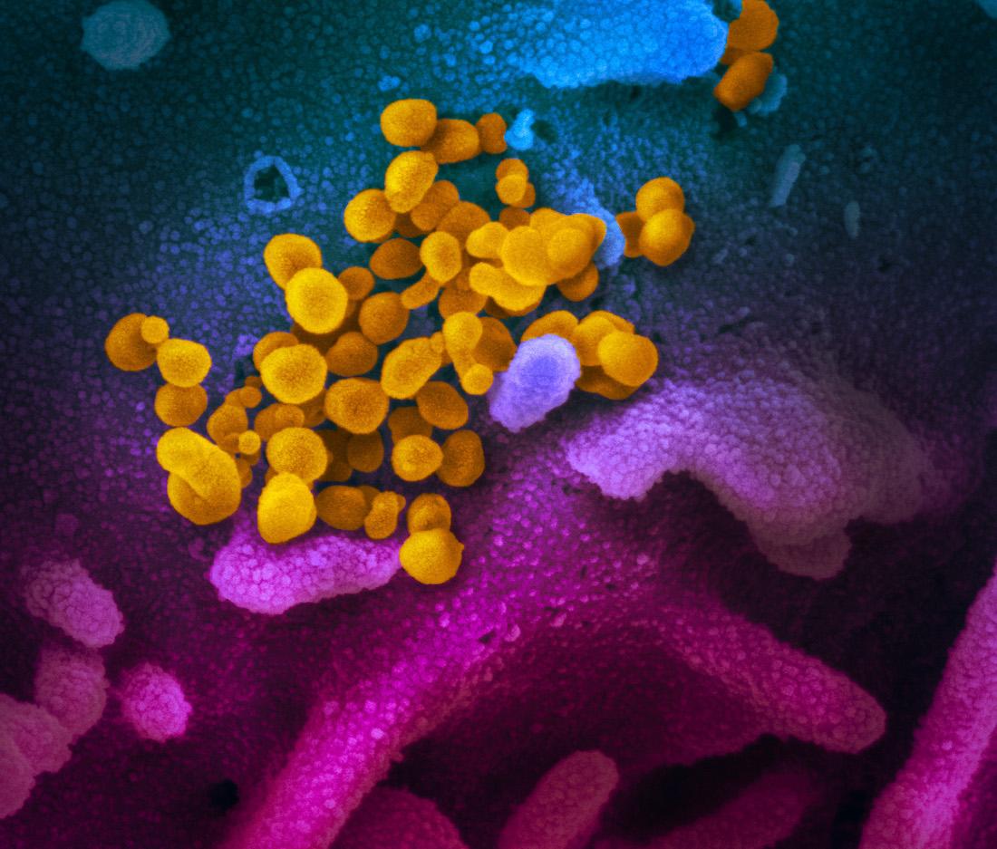 This scanning electron microscope image shows SARS-CoV-2 (yellow)&#8212;also known as 2019-nCoV, the virus that causes COVID-19&#8212;isolated from a patient in the U.S., emerging from the surface of cells (blue/pink) cultured in the lab. (Courtesy of NIAID-RML)